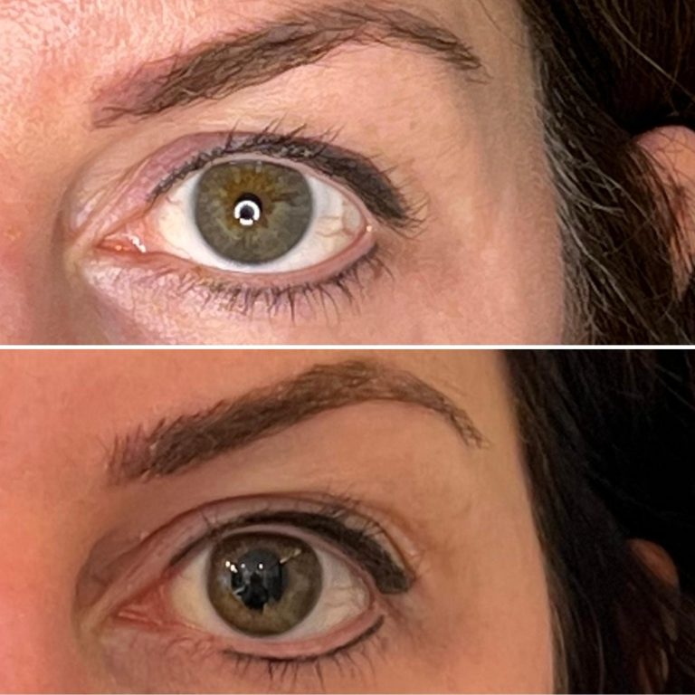 Brow lift