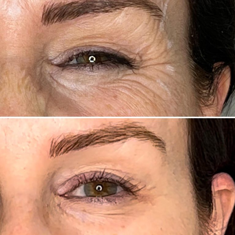Crows feet