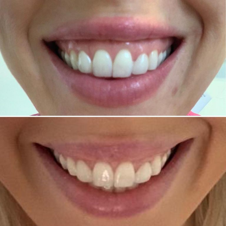 Gummy smile