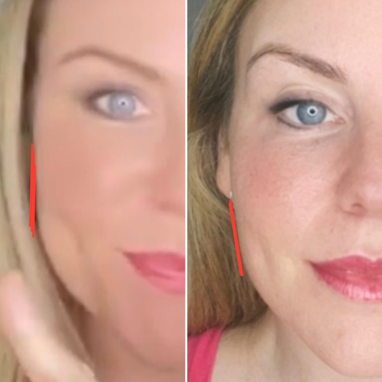 Jawline slimming